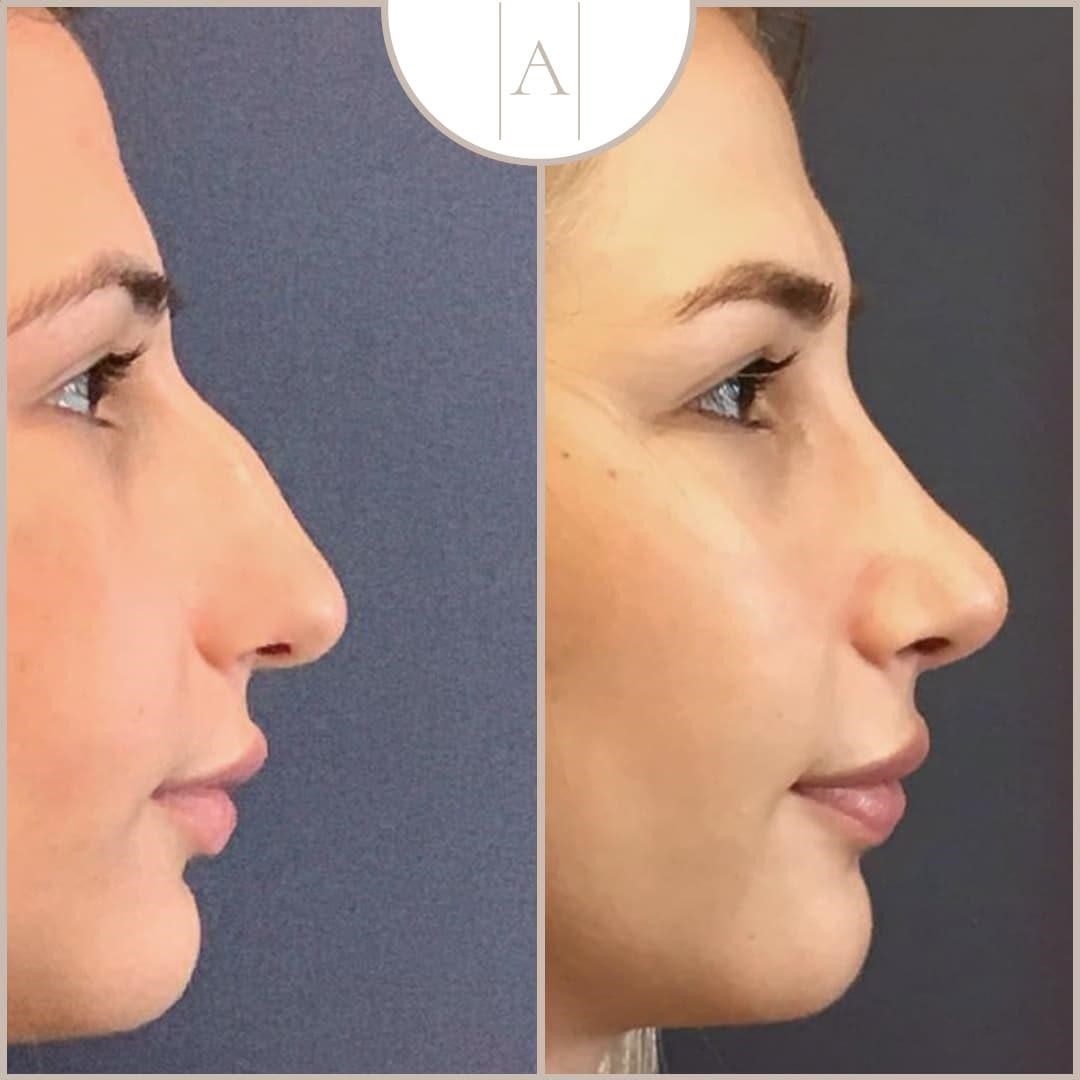 rhinoplasty nose surgery