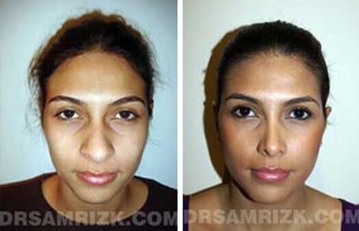 rhinoplasty nose surgery