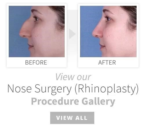 rhinoplasty nose surgery